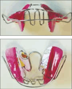 Photograph of a Mouth Slow Balance (MSB) device, an orthodontic appliance made of acrylic resin and wire that resembles a traditional retainer. 