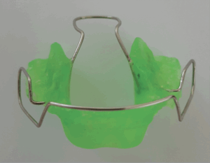 Photograph of a Binator device, an orthodontic appliance made of acrylic resin and wire that resembles a traditional retainer. 