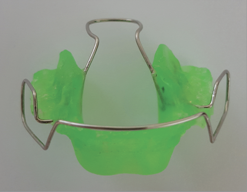Photograph of a Binator device, an orthodontic appliance made of acrylic resin and wire that resembles a traditional retainer.