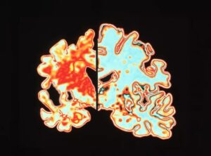 Imaging of a vertical (coronal) slice through the brain of an Alzheimer patient (left) compared with a normal brain ( right).