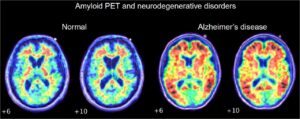Amyloid PET scan of patient with Alzheimer's Disease (right), and patient without Alzheimer's (left). Patient with Alzheimer's Disease shows higher detection of Amyloid plaques. 