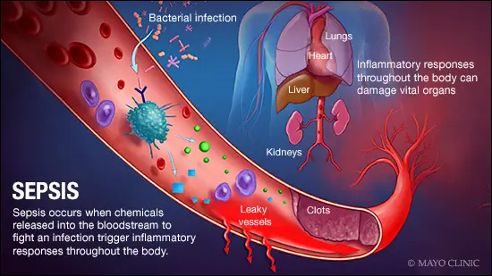A diagram showing the stages and symptoms of sepsis